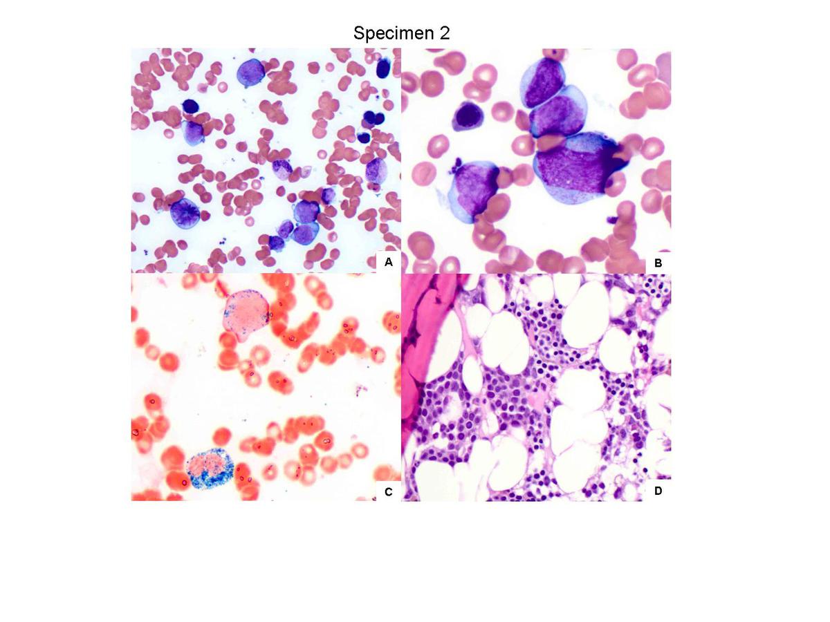 Figure 3. Review of microscopic findings from specimen 2. (A) and (B) Bone marrow smears showed increased blasts raging from small to intermediate, some with cytoplasmic granules. Maturing myeloid elements and erythroid precursors were markedly reduced with relative erythroid predominance (A, 500x; B, 1000x). (C) Myeloperoxidase (MPO) was weakly positive in approximately 20% of blasts when compared to the strong cytoplasmic stain of granulocytes. (D) Bone marrow biopsy showed a cellularity of 30-40% with interstitial clusters of immature cells (400x).